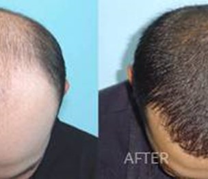 The Hair Restoration Experts