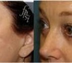 Eyelid_surgery_can_be_a_simple_procedure_Contact_us_for_more.jpg
