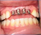 dentalimplantbountifulutah.jpg
